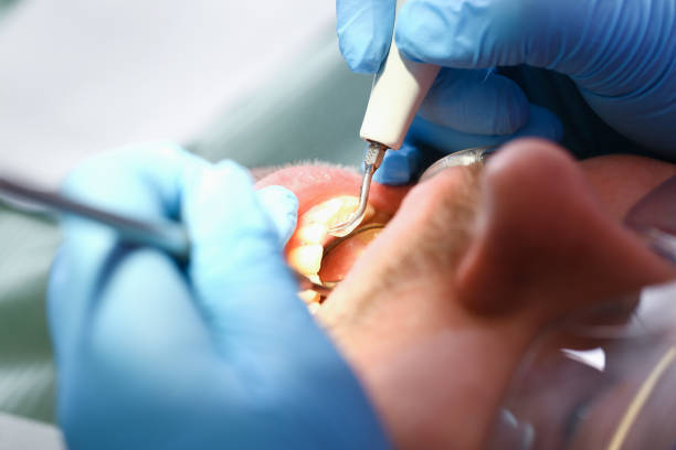 Best Emergency Tooth Extraction in Madeira, OH