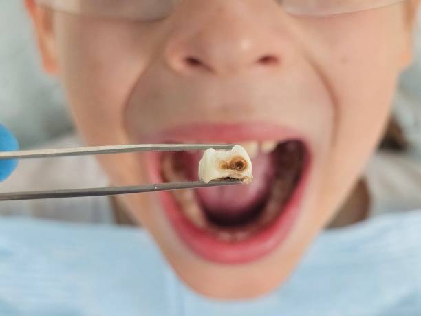 Best Urgent Care for Lost Fillings or Crowns in Madeira, OH